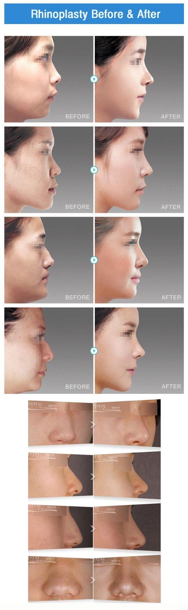 rhinoplasty surgeons near me