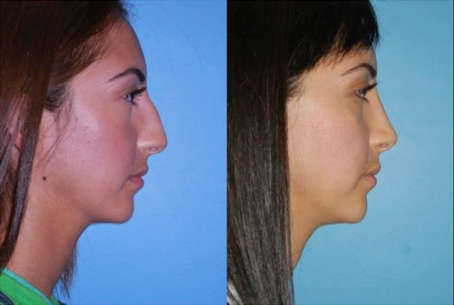 closed vs open rhinoplasty