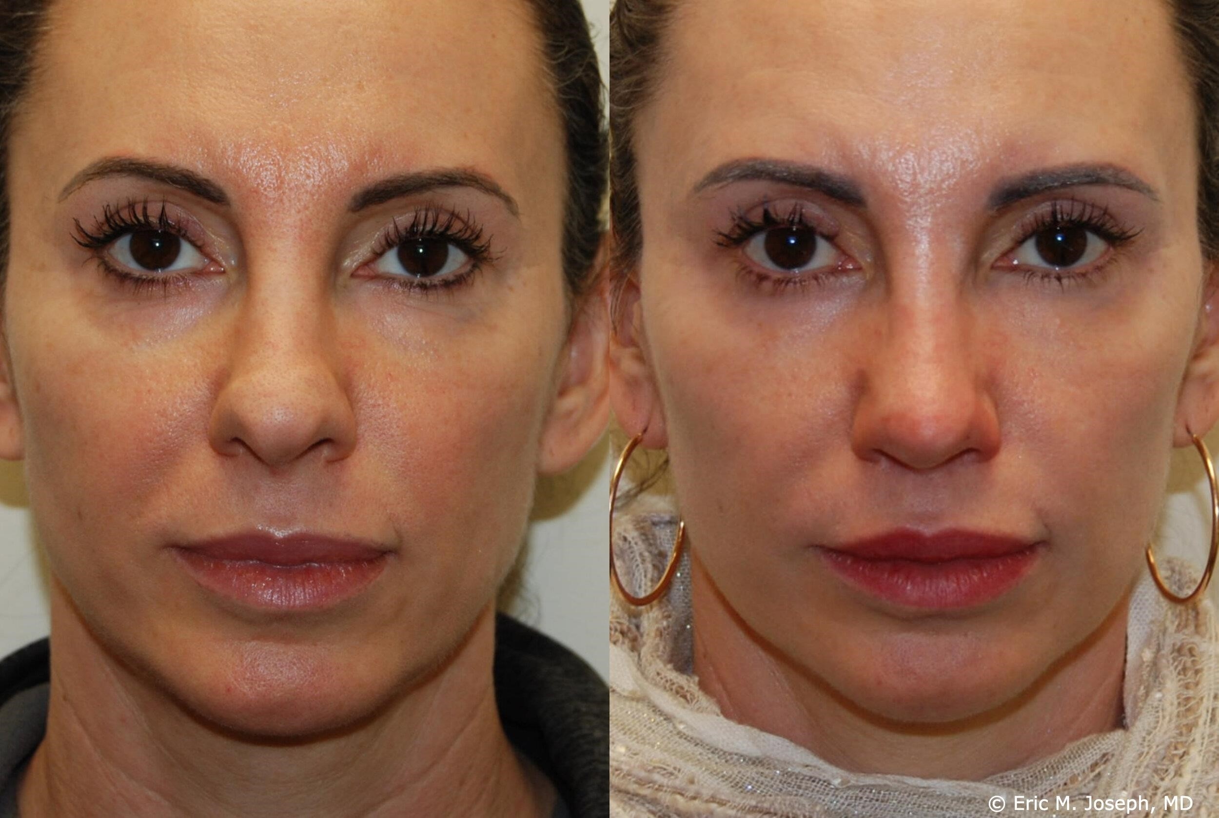 closed vs open rhinoplasty