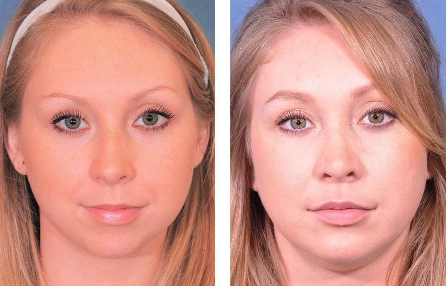 rhinoplasty surgeons near me